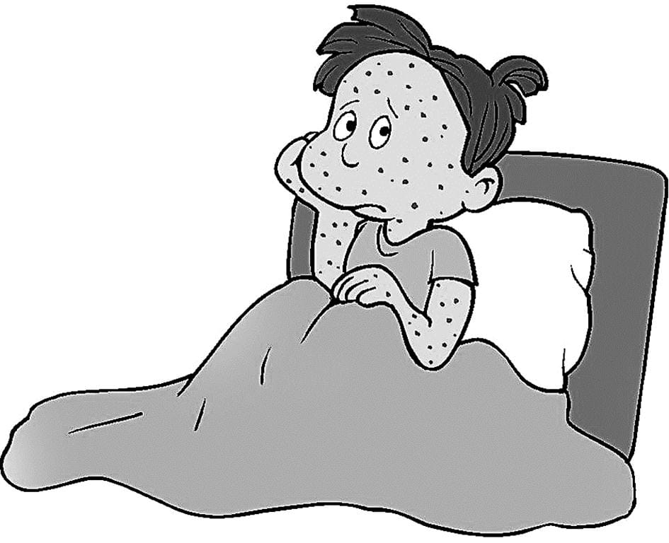 chickenpox causes and symptoms in hindi, Tips to prevent chickenpox infection