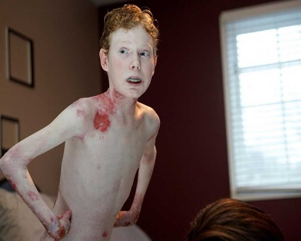 Butterfly Boy: His skin tears like a butterfly’s wings, 