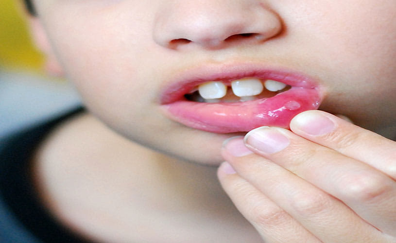 homemade treatment for mouth ulcer