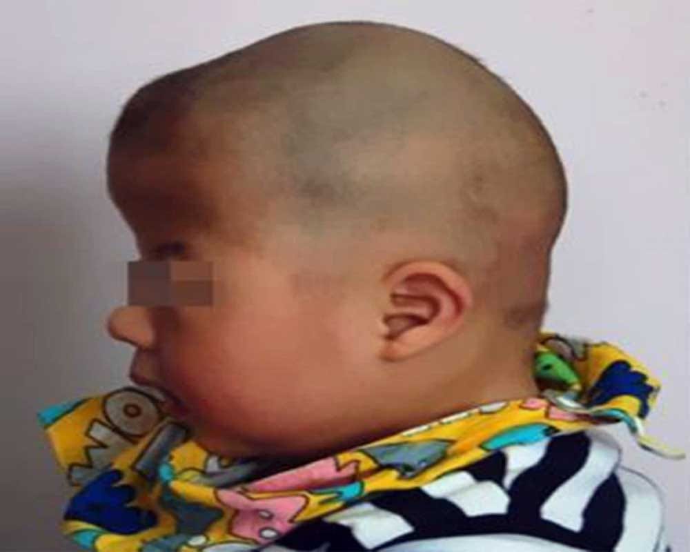 Alien Boy: Boy having rare skull defect