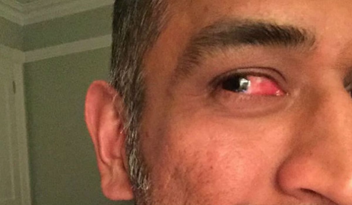 eye infection and flu related diseases
