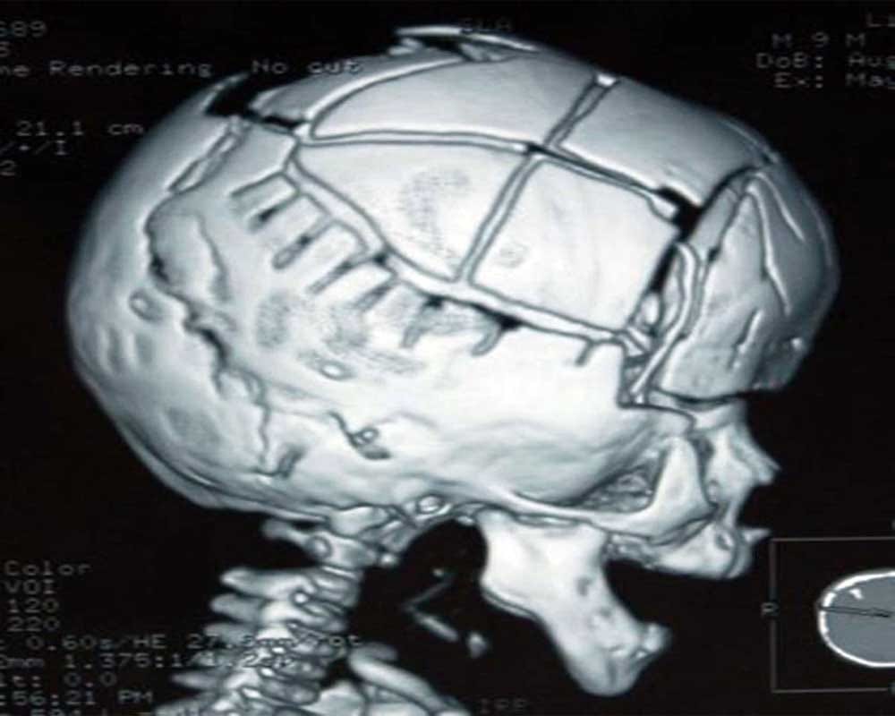 Alien Boy: Boy having rare skull defect