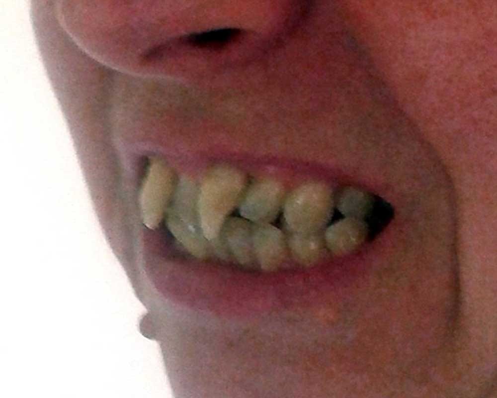 Her teeth turned into vampire fangs