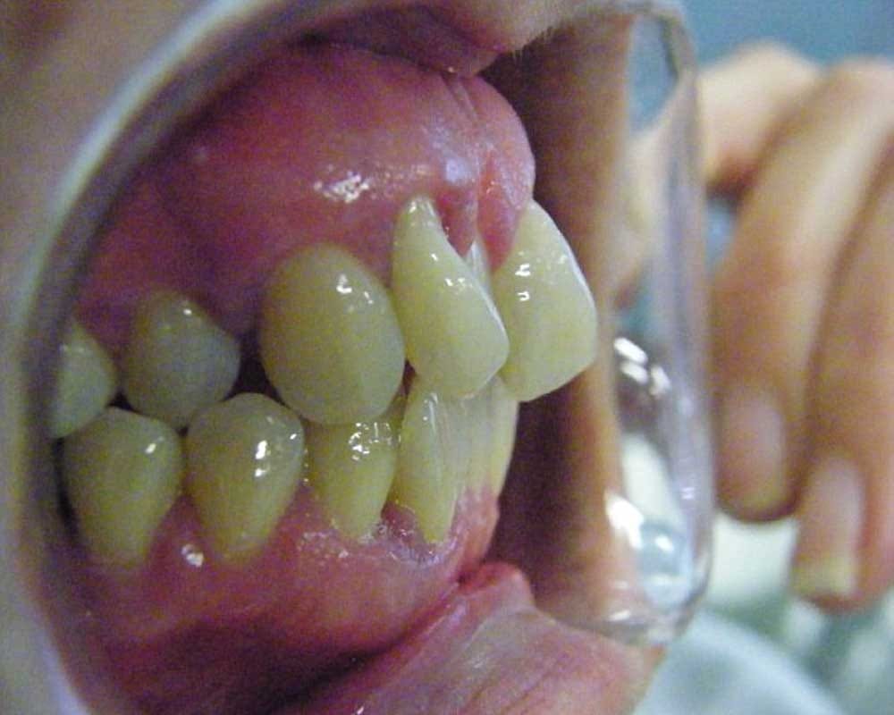 Her teeth turned into vampire fangs