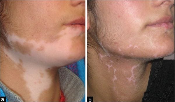 world vitiligo day, vitiligo disease, health news, chandigarh pgi, health, chandigarh, vitiligo