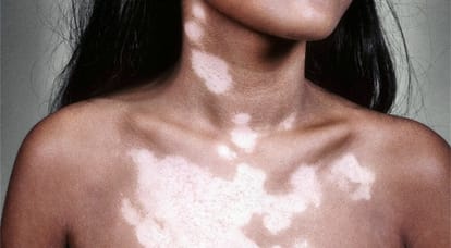 world vitiligo day, vitiligo disease, health news, chandigarh pgi, health, chandigarh, vitiligo
