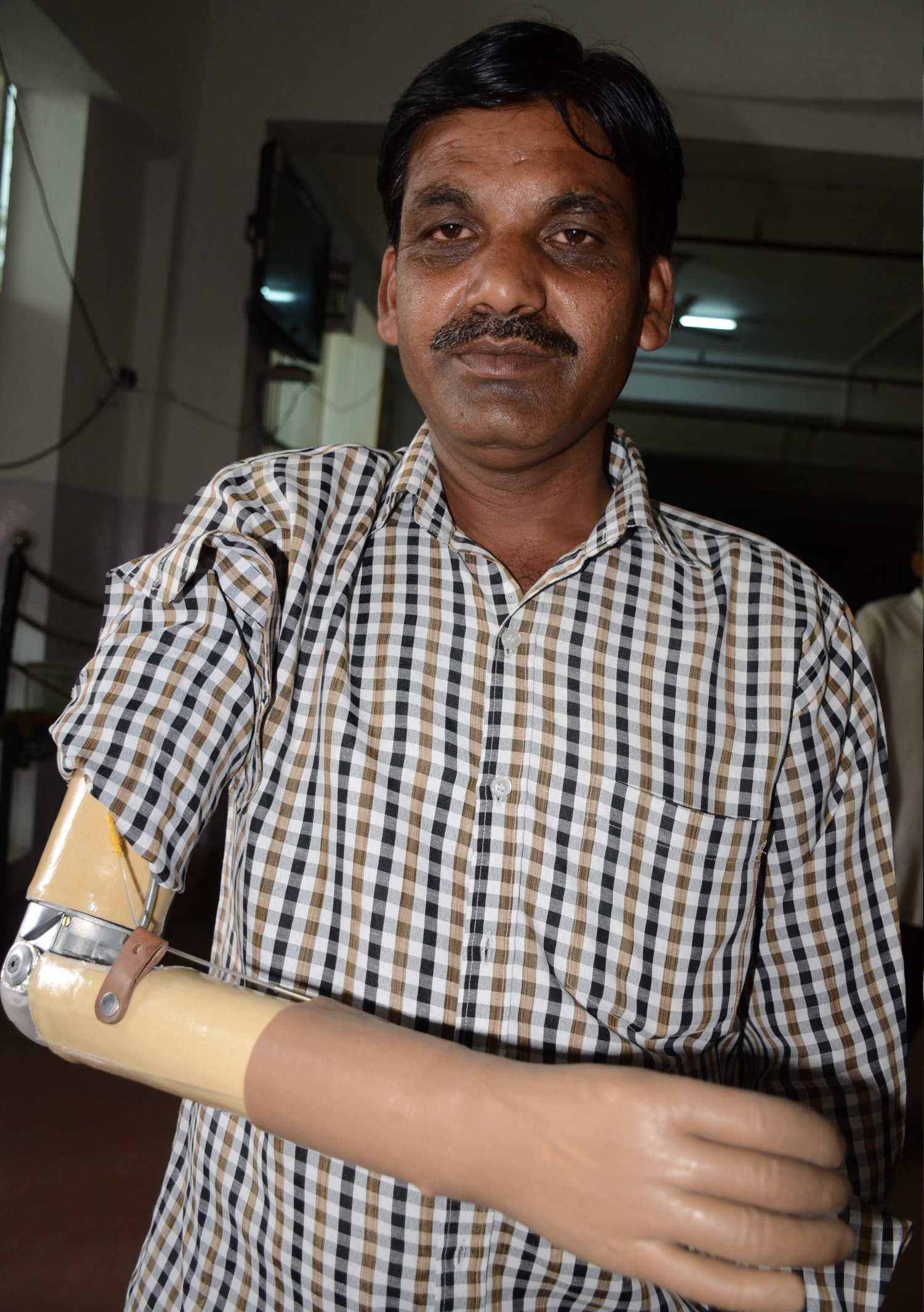 amar ujala and indresh hospital distributed Artificial limbs