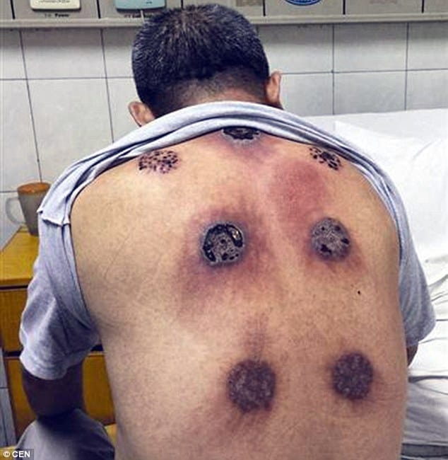 when cupping therapy goes wrong