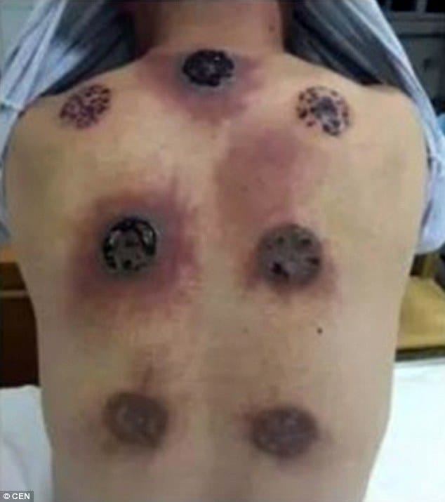 when cupping therapy goes wrong