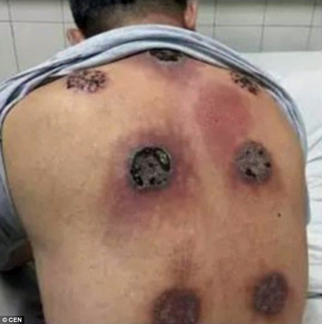 when cupping therapy goes wrong