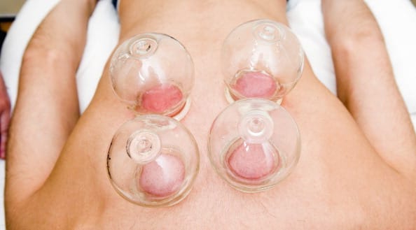 when cupping therapy goes wrong