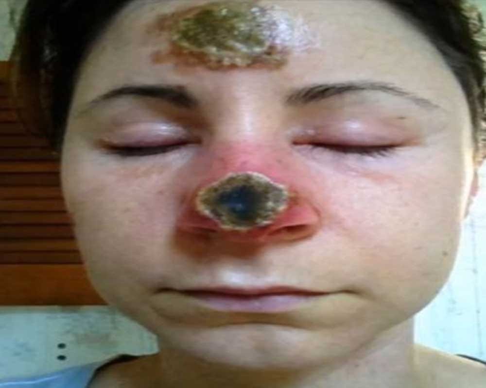 After Using Herbal Treatment Woman Left With Huge Hole In Her Nose