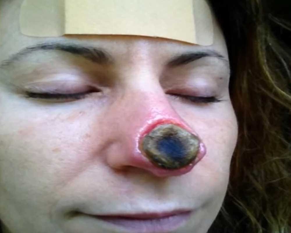 After Using Herbal Treatment Woman Left With Huge Hole In Her Nose