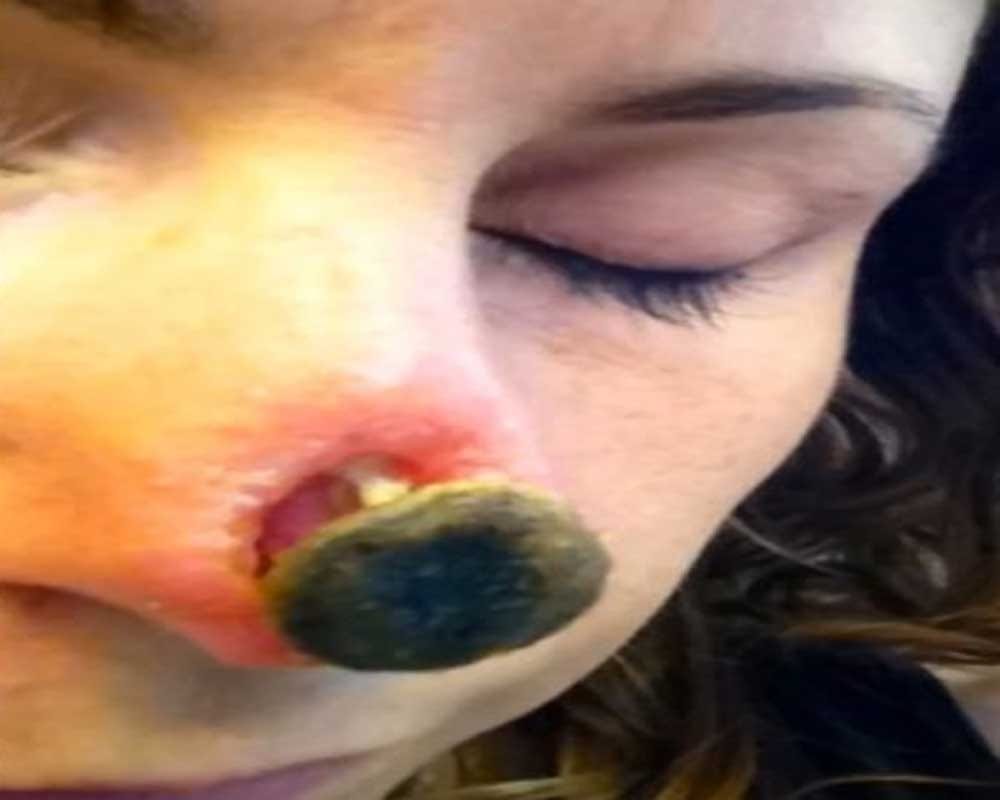 After Using Herbal Treatment Woman Left With Huge Hole In Her Nose