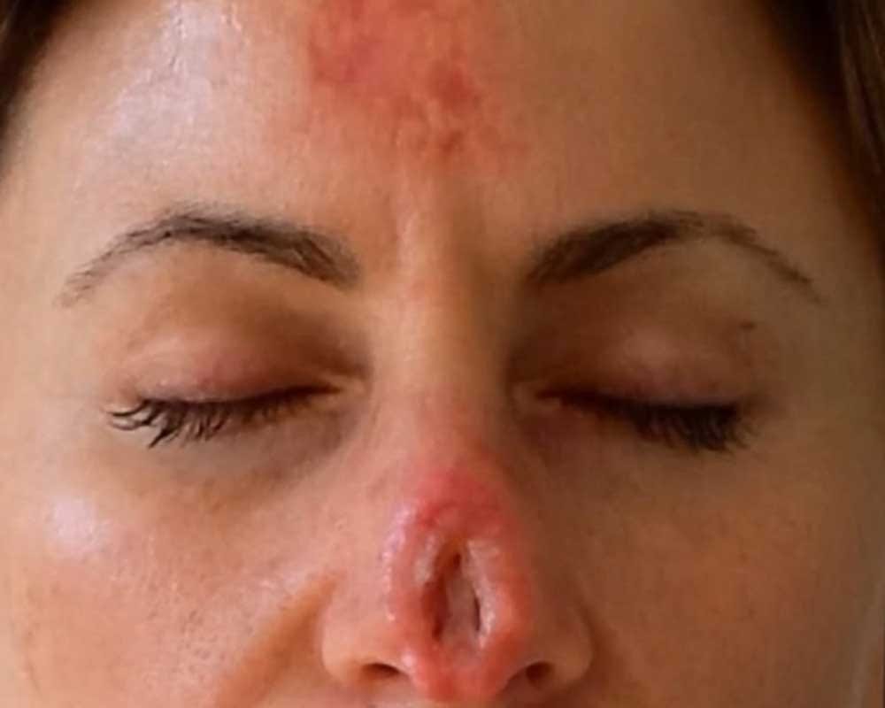 After Using Herbal Treatment Woman Left With Huge Hole In Her Nose