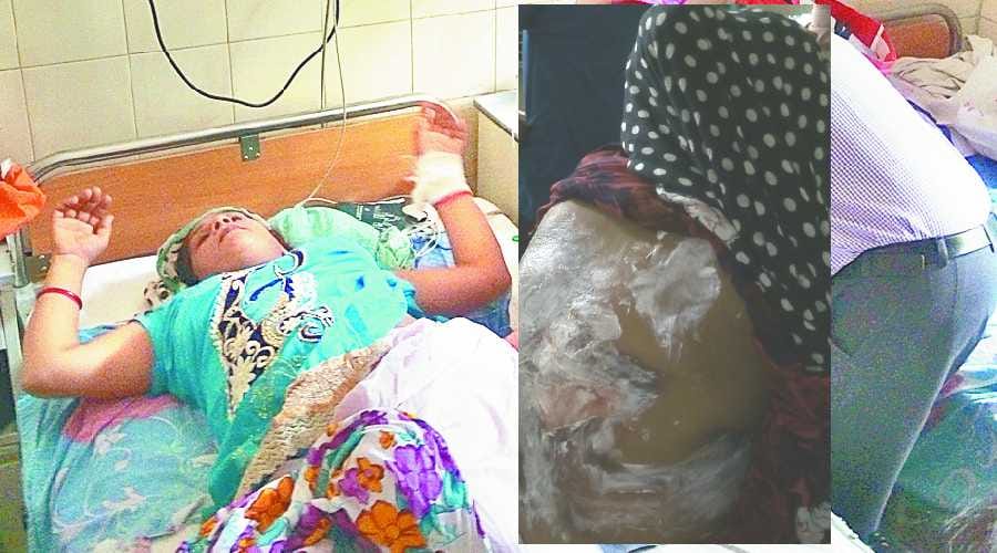 women burned, burned after delivery, civil hospital, Health, patient burn by medicine, sirsa