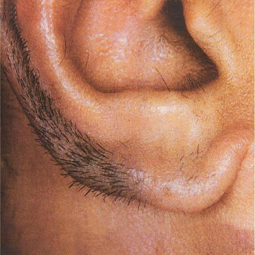 Hair In Ear Is A Warning of heart attack