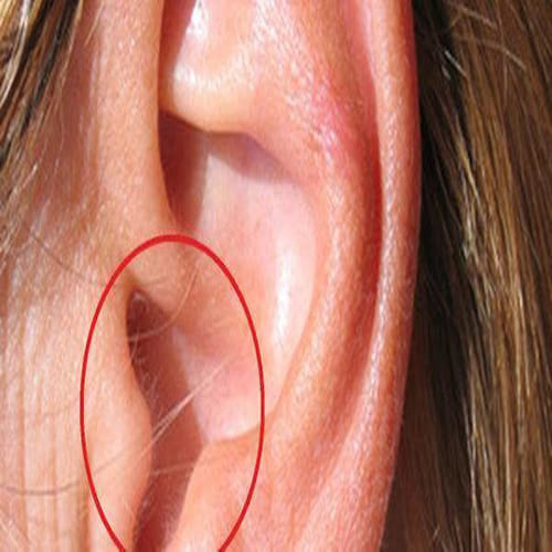 Hair In Ear Is A Warning of heart attack