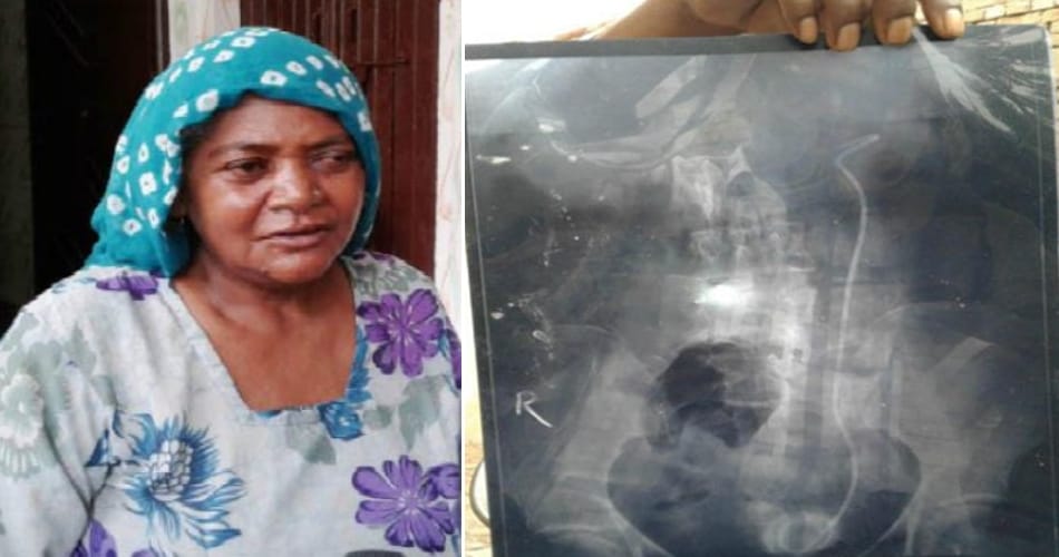 wire in lady stomach found during operation, ajab gajab operation in hisar