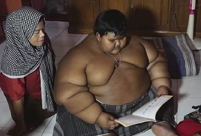 Indonesian child suffering from morbid obesity 