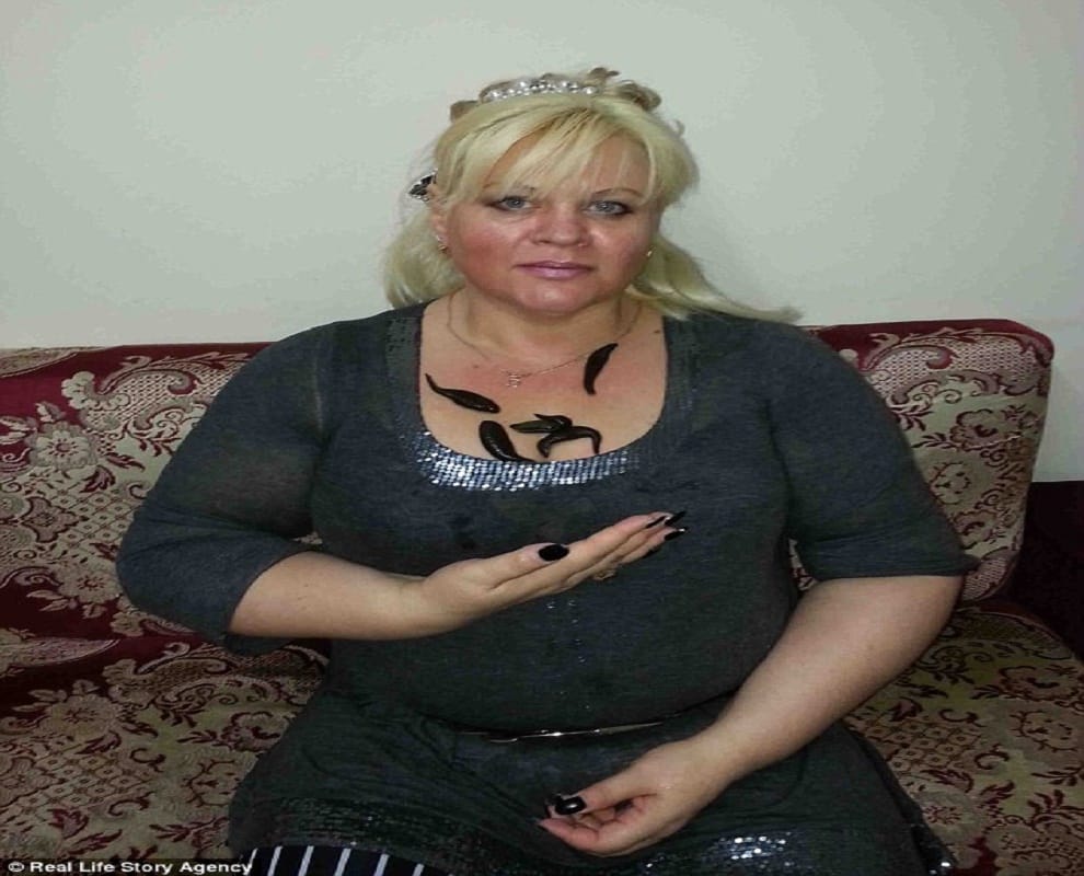 woman claims she lost weight leeches suck her blood