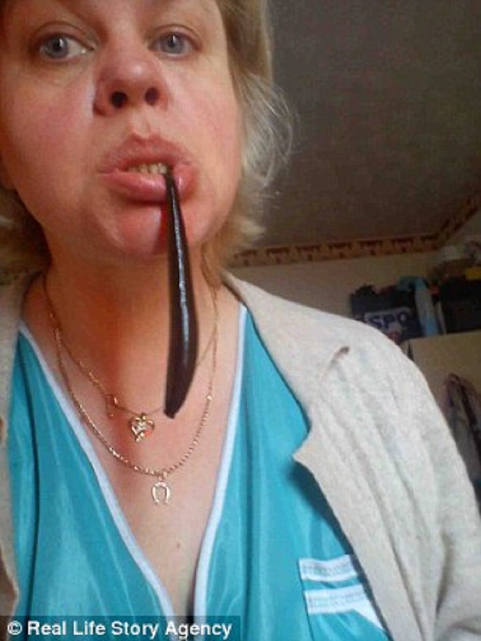 woman claims she lost weight leeches suck her blood