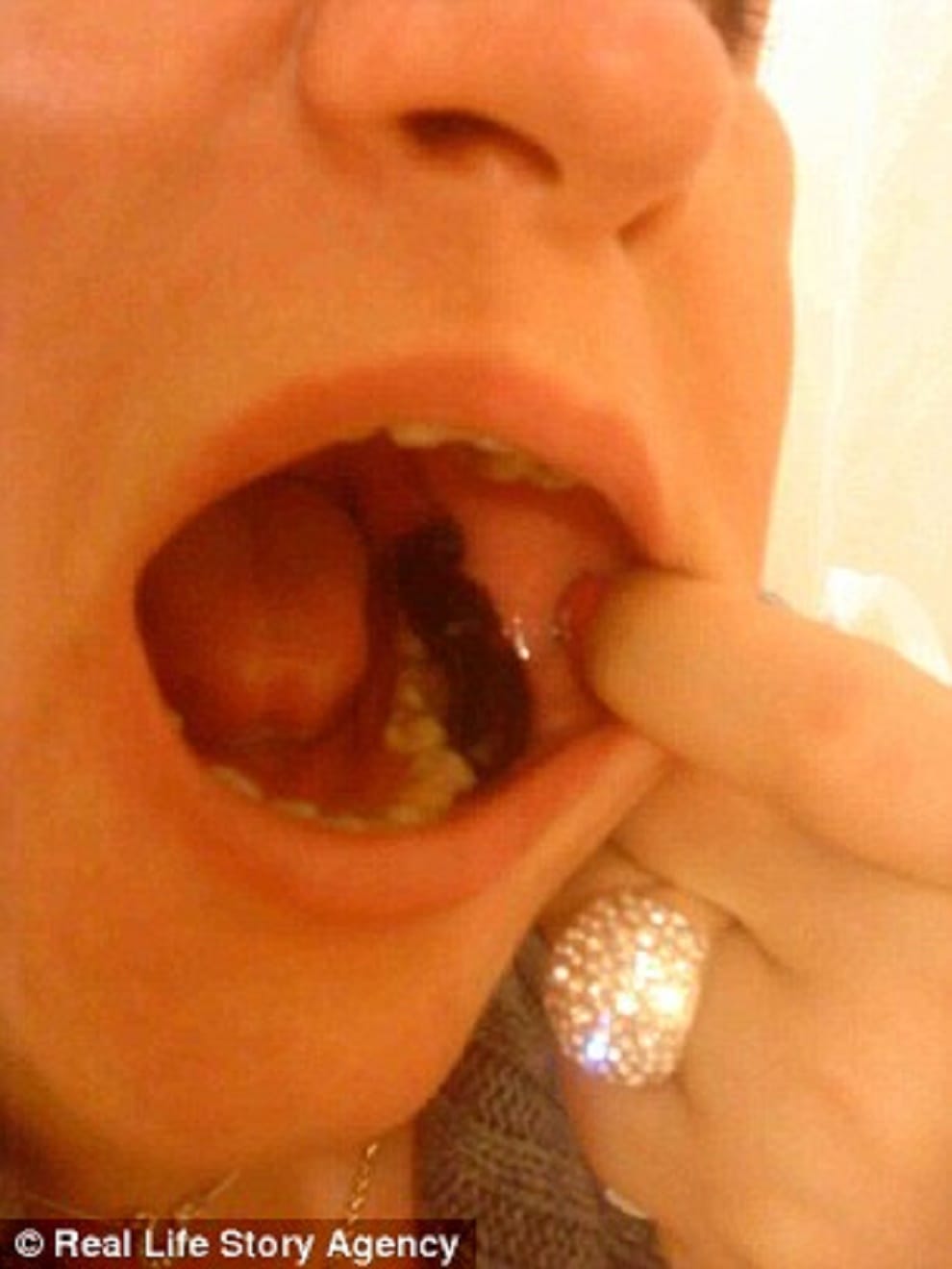 woman claims she lost weight leeches suck her blood