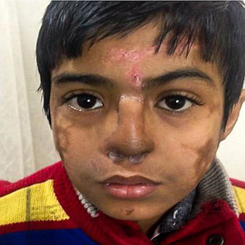 this boy has nose on his forehead