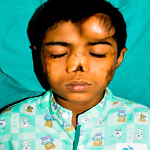 this boy has nose on his forehead