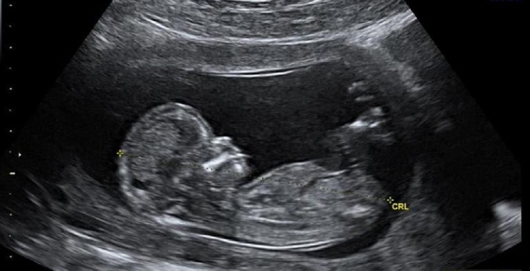 two baby death in womb in uttarakhand government hospital