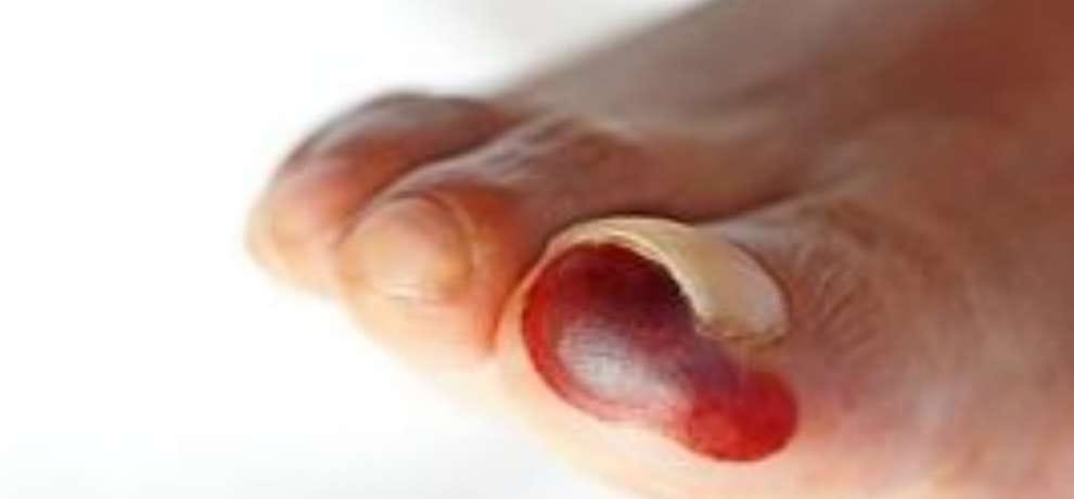 Research reveals that Diabetes can cause gangrene in footprints
