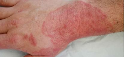 Steroid containing drugs can increase fungal infection