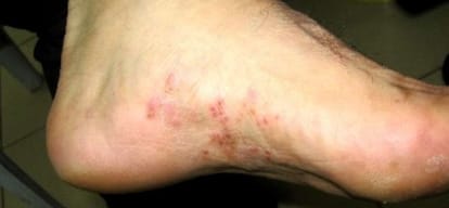 HIV and Diabetes patients take safe themselves from fungal infection