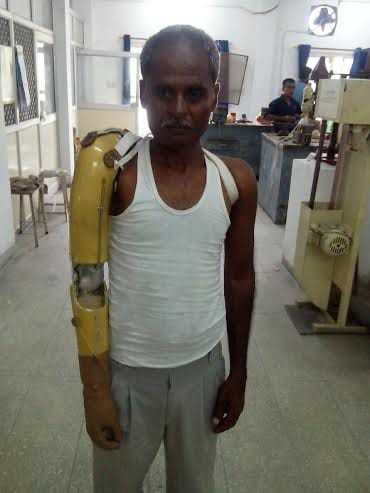 doctors placed plastic mechnical hand to patient in kgmu