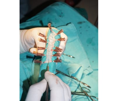 Rare surgery in KGMU Lucknow.