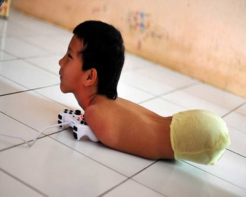 Boy without arms and legs learned to play computer games with his CHIN