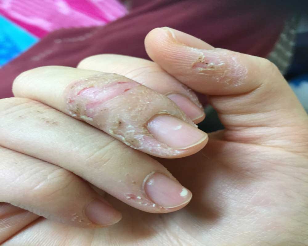 Adverse effects of nail biting