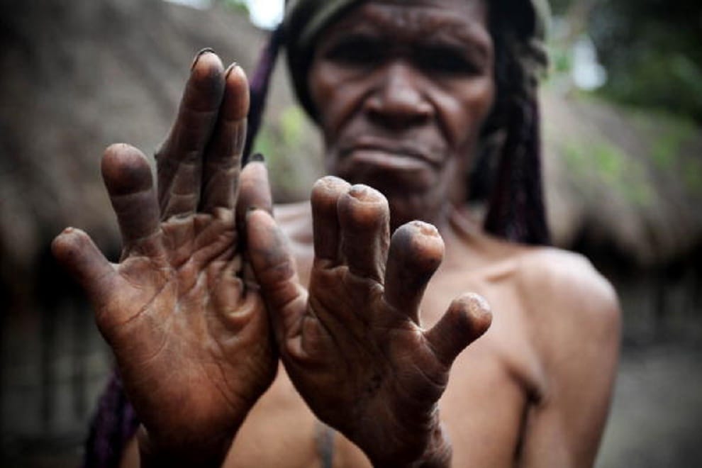 wife fingers cut down after husband death