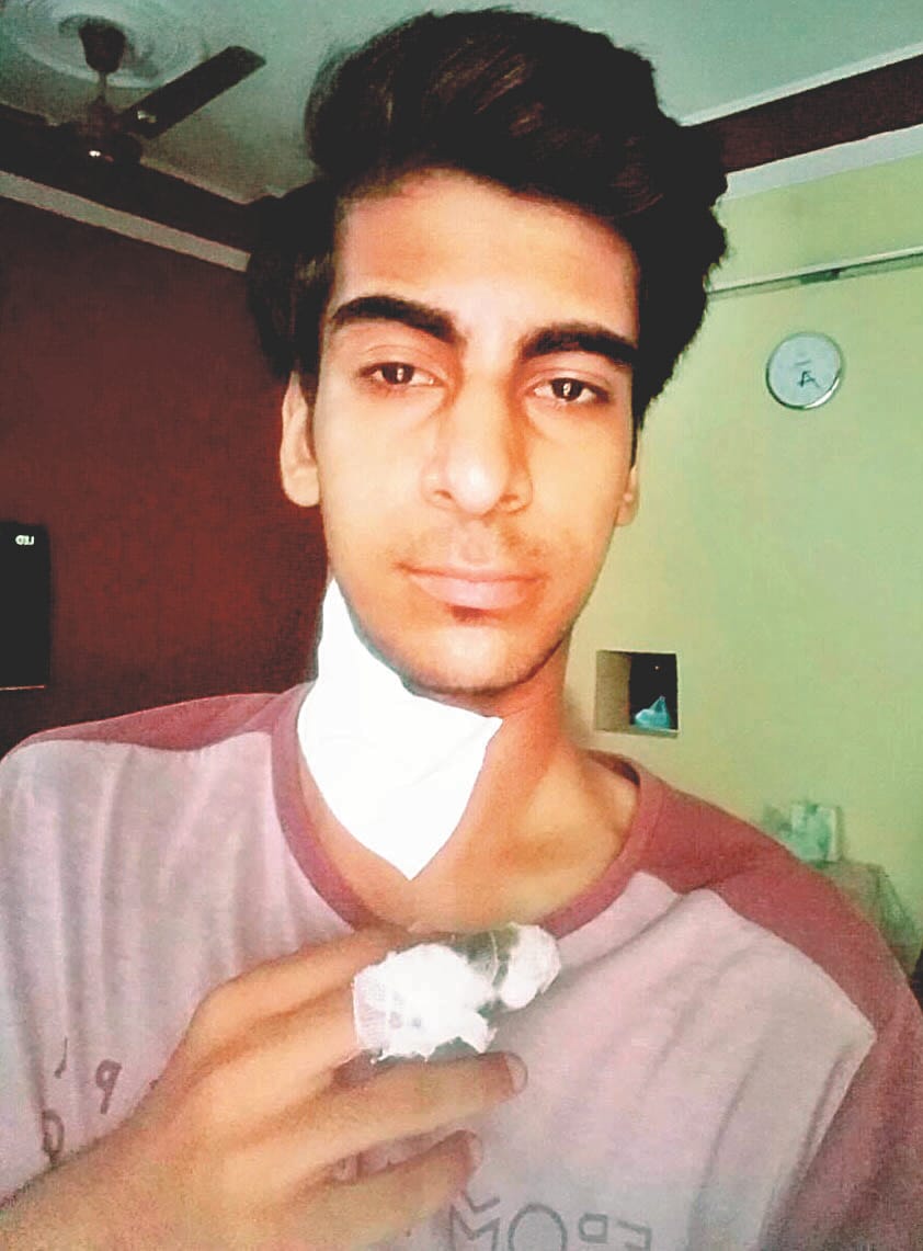 Chinese Manjha again entangled in the neck, four stitches