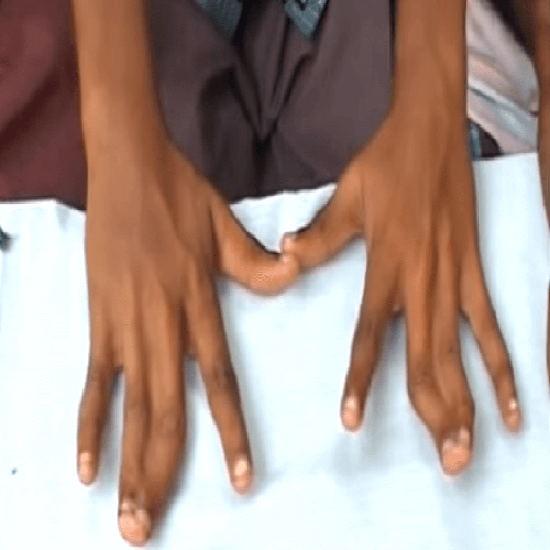 140 family members With Webbed Fingers
