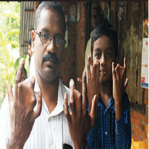 140 family members With Webbed Fingers