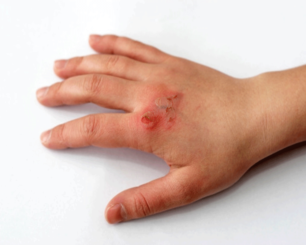 Home Remedies Of Mehandi