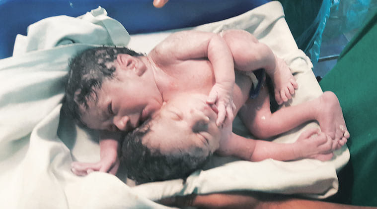 Rare conjoined twins born with separate brains in Mumbai