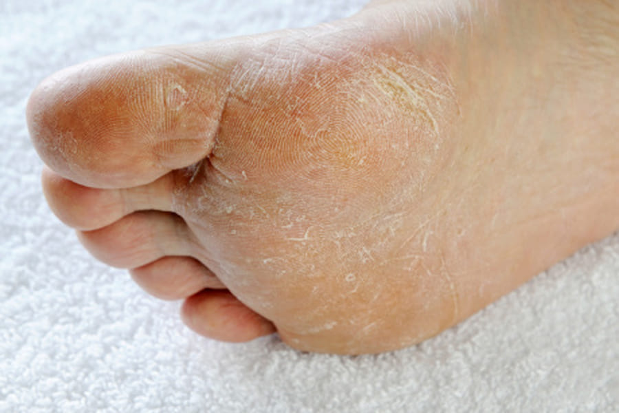 tight shoes in rainy season can cause some infection