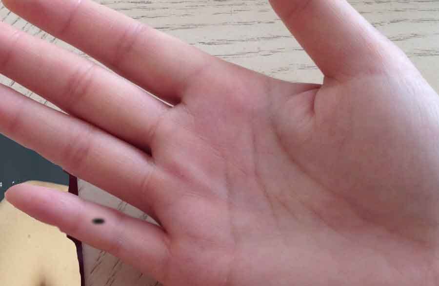 Connection between mole and your fate in palmistry