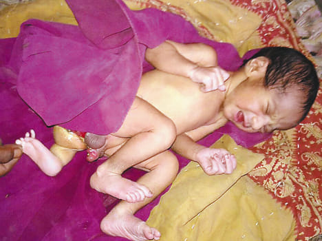 Baby born with three legs in Bulbulakedha