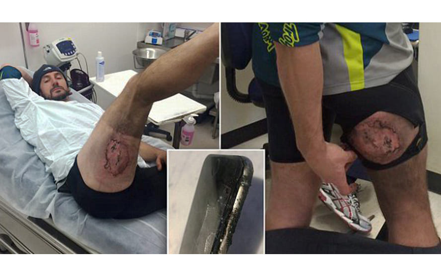 Man Sustains Severe Burns After iPhone 6 Explodes In His Pocket