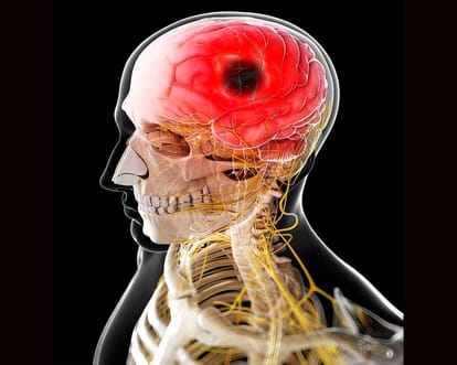world brain stroke day, too little and too much sleep injurious for health