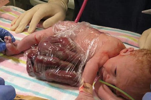 baby born with his organs outside his body 