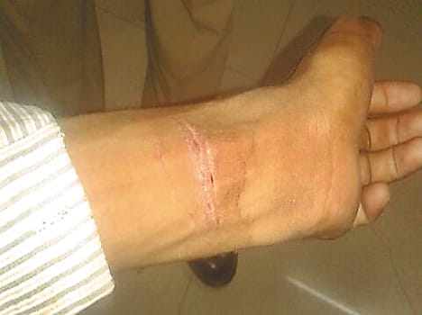 Police accused of theft arm vein cut